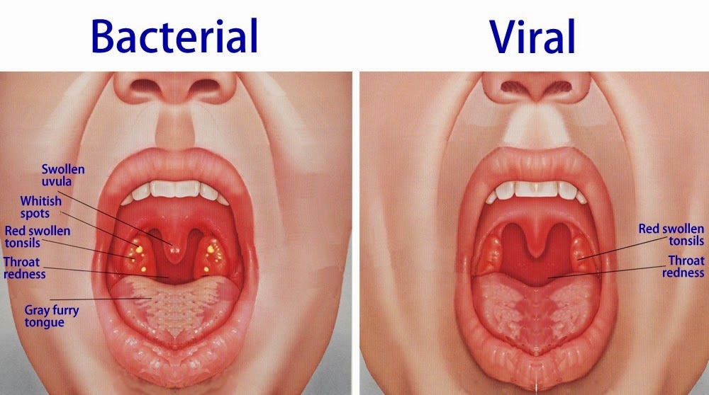 [tonsillitis%2520home%2520remedies%255B8%255D.jpg]
