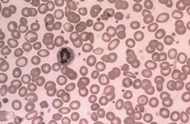 Hypochromic red blood cells may be seen in microcytic anaemia