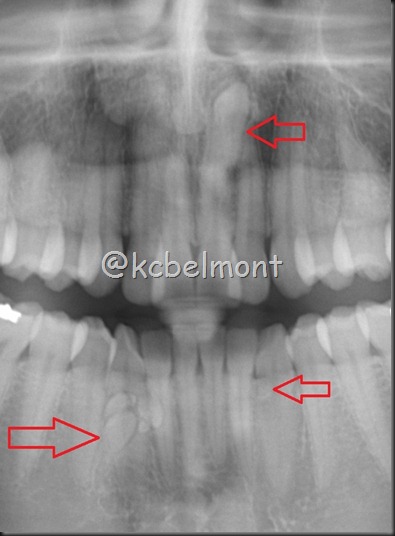 odontoma inferior e supra supra