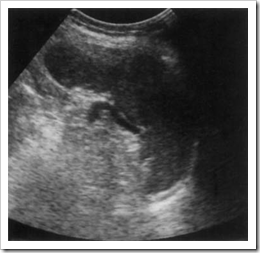 Ultrasound images of spleen - Radiology Imaging