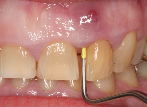 home remedies for abcessed tooth_3