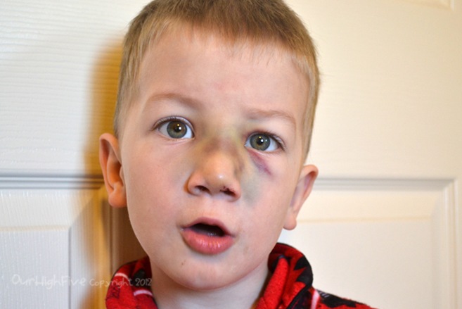 High 5: Broken Nose Progress