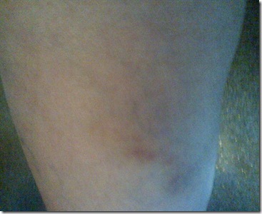 bruise day 13