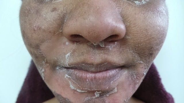 skin peeling 2