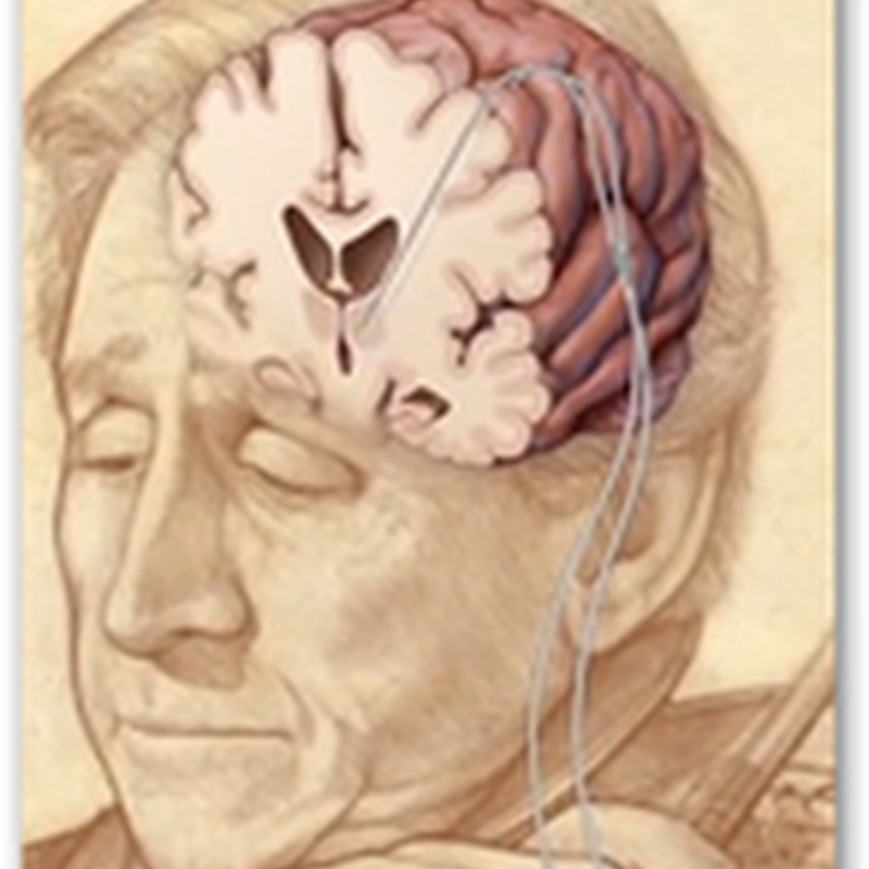 Patient Plays The Violin During His Surgery For Essential Tremors-Deep Brain Stimulation Saves the Career of a Concert Violinist
