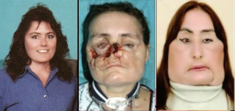 [connie%2520culp%2520fotos%2520transplante%2520cara%2520%25283%2529%255B3%255D.jpg]