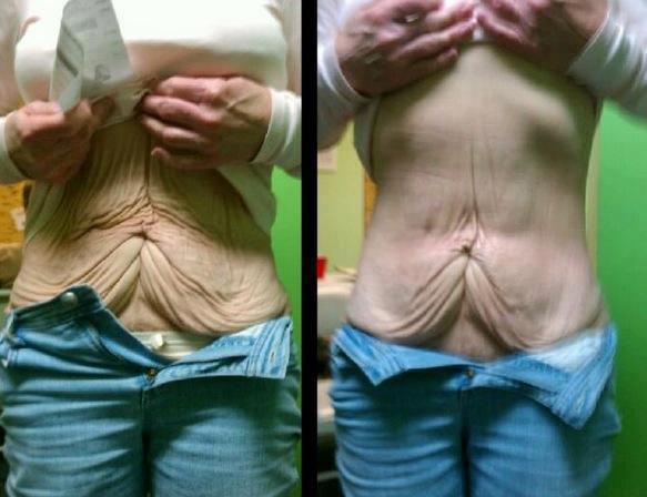 gastric bypass surgery tightening tighten heger ashlee