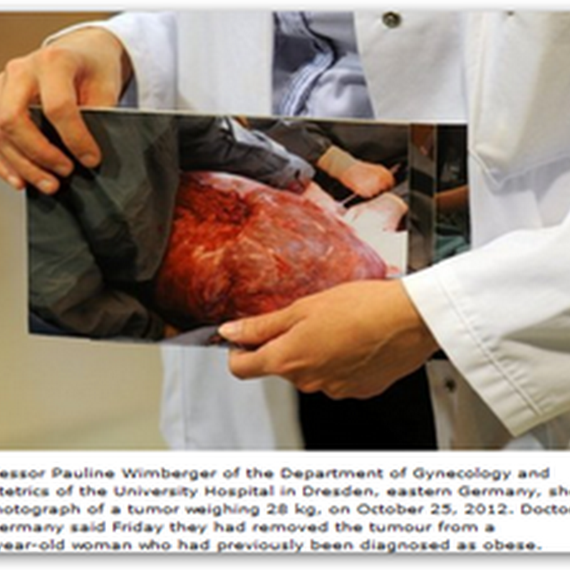 Doctors in Germany Remove 62 Pound Tumor From Woman Who Had Been Diagnosed as Obese