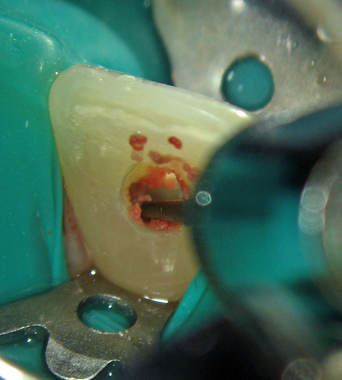 [Removing-pulp-tissue0193.jpg]
