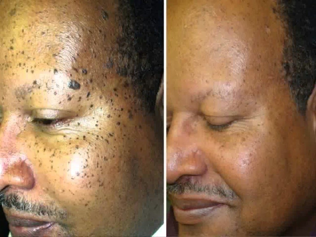 [home%2520remedies%2520for%2520mole%2520removal_3%255B4%255D.jpg]