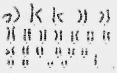 kromosom sindrom turner