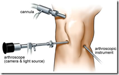 Anterior Cruciate Ligament Arthroscopic Repair Surgery Patient Education #videosysalud