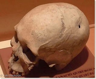 Cova d´En Pardo - cráneo trepanado