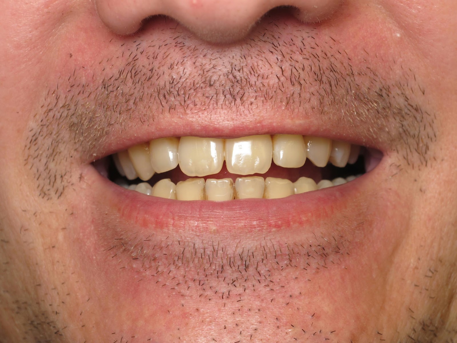 Cost Of Braces Average Cost Of Braces For 2 Years