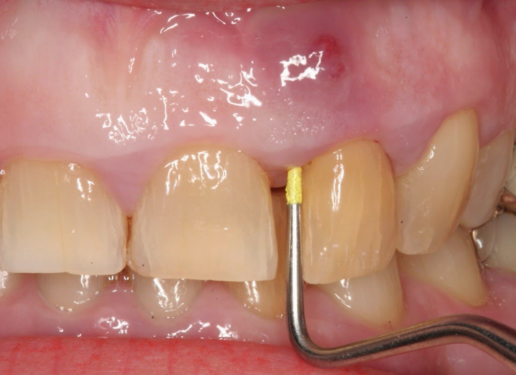 [home-remedies-for-abcessed-tooth_34.jpg]