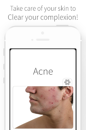 Acne - Causes and Remedies