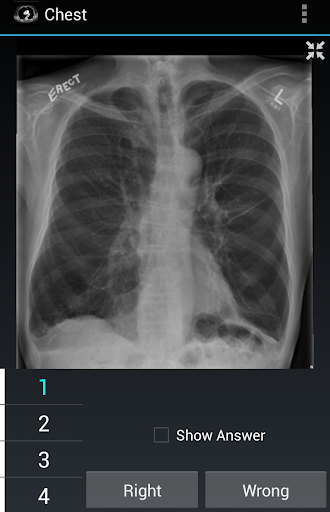 Radiology Flashcards: Chest