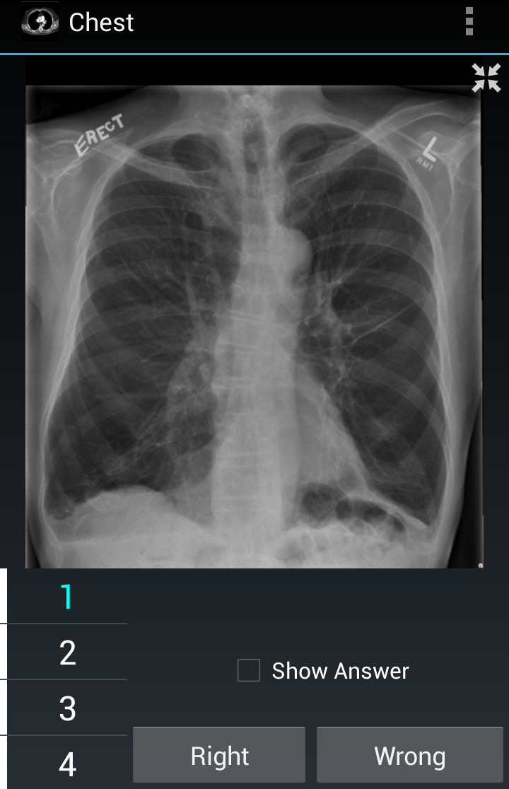 Radiology Flashcards: Chest Screen 1