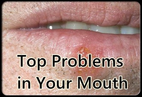 How to install Top Problems in Your Mouth 1.0 apk for pc