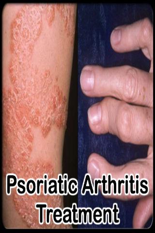 Psoriatic Arthritis Treatment