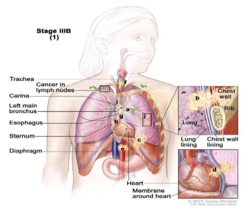 dental remedy for breast cancer sufferers