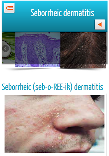 Seborrheic Dermatitis