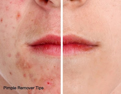 How to get Pimple Remover Tips patch 1.7 apk for android