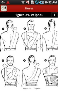 Bandaging and Splinting Screenshots 4