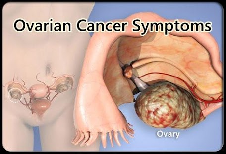 How to install Ovarian Cancer Symptoms 1.0 unlimited apk for android