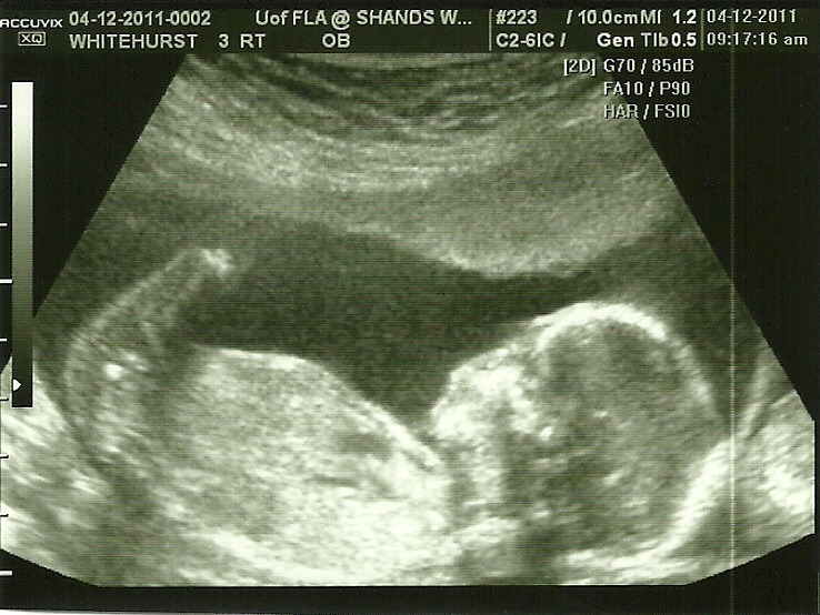 [Baby 3 Profile @ 17 weeks[3].jpg]
