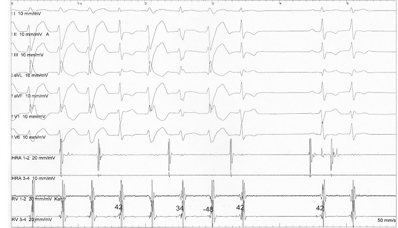 Electrophysiology- cases