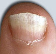 [fungal-nail_default[11].jpg]