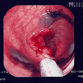 India Ink Tattoo / Indian Ink Tattoo Removal - Bristol Laser Centre - India ink is also used in medical applications.