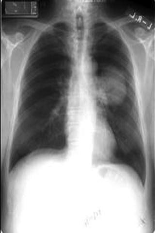 Pulmonary Review Questions
