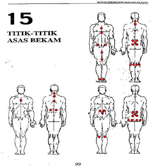titik%20bekam.jpg