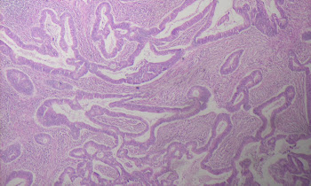 Esophagus Cancer Dogs