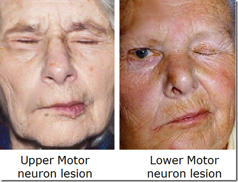 upper motor neuron lesion