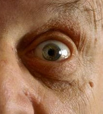 implanted telescopes