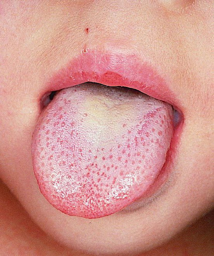 Scarlet fever: Strawberry tongue, other symptoms, & treatment