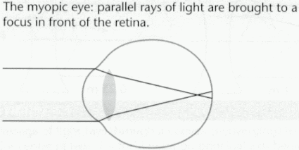 The Nearsighted (Myopic) Eye  