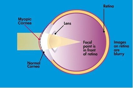 The Nearsighted (Myopic) Eye 