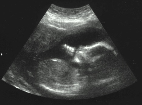 Baby_in_ultrasound-Wikipedia-GS.jpg