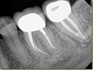 Endodontic Complexity postop2b