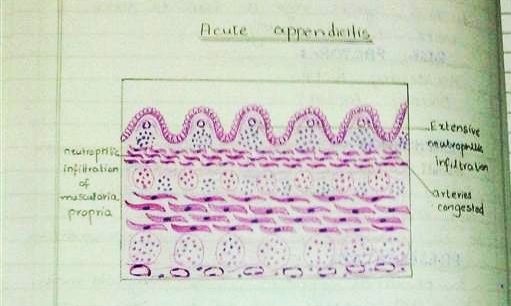 [acute appendicits diagram H&E[2].jpg]