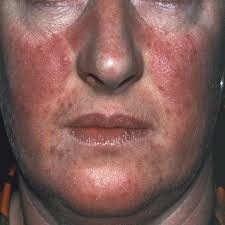 [acne face[3].jpg]