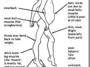White Muscle Disease In Humans