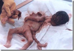 Aborted Baby