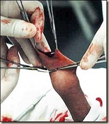 circuncisión