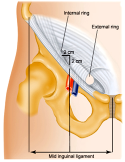 The inguinal canal.