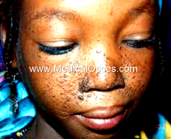 6 year old child presented with a rash